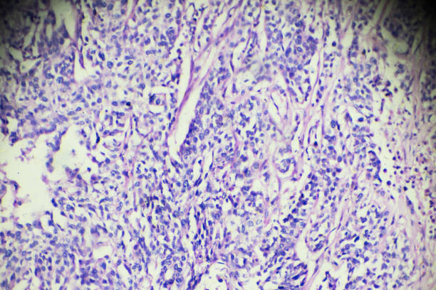 Transitional cell cancer of bladder under microscopy Transitional cell cancer of bladder under microscopy zoom in different areas urothelium stock pictures, royalty-free photos & images
