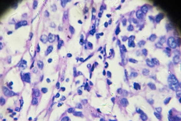 Transitional cell cancer of bladder under microscopy Transitional cell cancer of bladder under microscopy zoom in different areas urothelium stock pictures, royalty-free photos & images