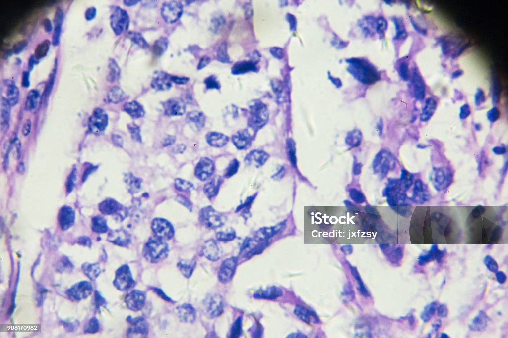 Virtsarakon siirtymäsolusyöpä mikroskopiassa - Rojaltivapaa avainsanalla Eturauhanen ja tyyppiä Kuvapankin valokuva Virtsarakon siirtymäsolusyöpä mikroskopiassa - Rojaltivapaa avainsanalla Eturauhanen ja tyyppiä Kuvapankin valokuva