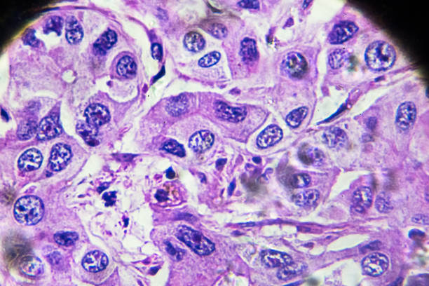 carcinoma hepatocelular hcc bajo microscopia - laboratory healthcare and medicine cancer drug histology fotografías e imágenes de stock