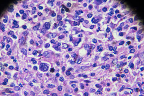 non-hodgkin’s lymphomas under microscopy - non hodgkin lymphoma imagens e fotografias de stock