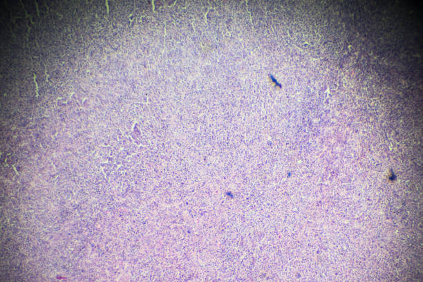 non-hodgkin’s lymphomas under microscopy - non hodgkin lymphoma imagens e fotografias de stock