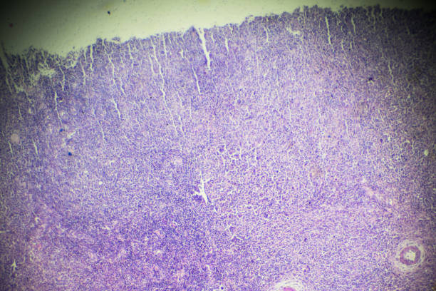 顕微鏡下の非ホジキン リンパ腫 - non hodgkin lymphoma ストックフォトと画像