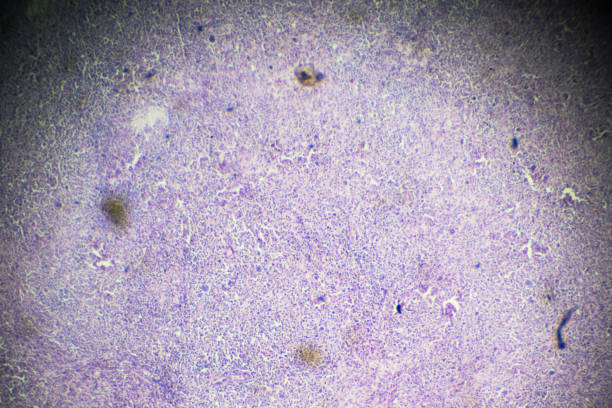 non-hodgkin’s lymphomas under microscopy - non hodgkin lymphoma imagens e fotografias de stock