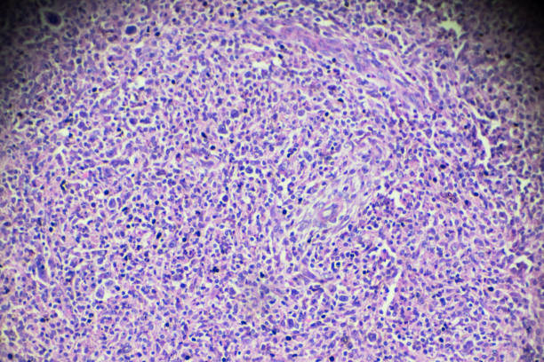 non-hodgkin’s lymphomas under microscopy - non hodgkin lymphoma imagens e fotografias de stock
