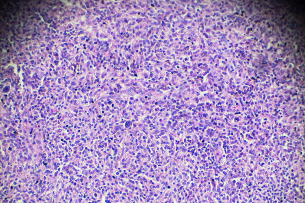 顕微鏡下の非ホジキン リンパ腫 - non hodgkin lymphoma ストックフォトと画像