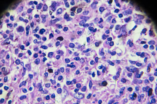 non-hodgkin’s lymphomas under microscopy - non hodgkin lymphoma imagens e fotografias de stock
