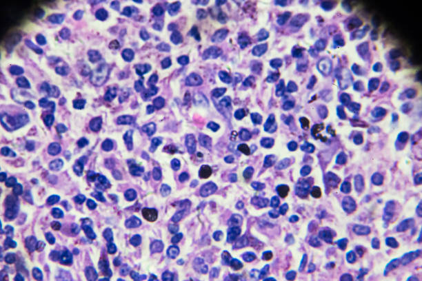 linfomas não-hodgkin sob microscopia - non hodgkin lymphoma - fotografias e filmes do acervo