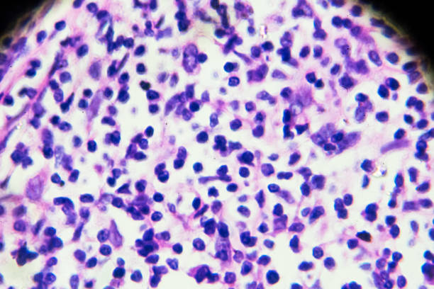 morbus hodgkin zellen, lymphom, hl unter mikroskopie - hodgkins disease stock-fotos und bilder