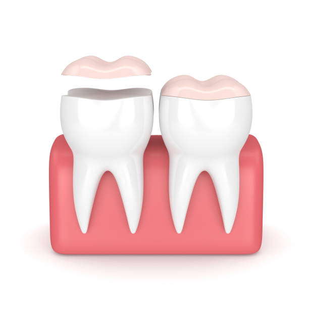 istock 3d render of teeth with dental onlay 908212778