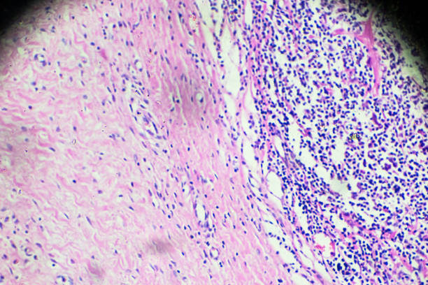 istock Hodgkin’s cells disease, Lymphoma, HL under microscopy 908213456