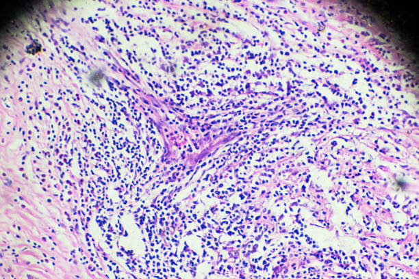 istock Hodgkin’s cells disease, Lymphoma, HL under microscopy 908214188