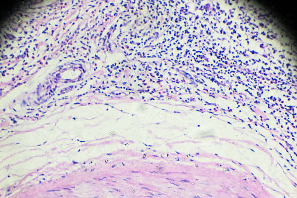 istock Hodgkin’s cells disease, Lymphoma, HL under microscopy 908216788