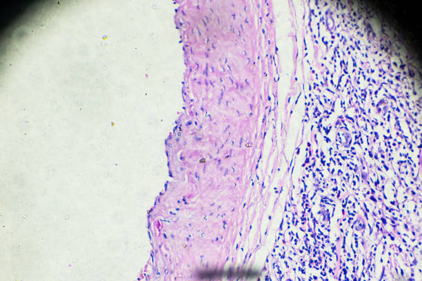istock Hodgkin’s cells disease, Lymphoma, HL under microscopy 908217014