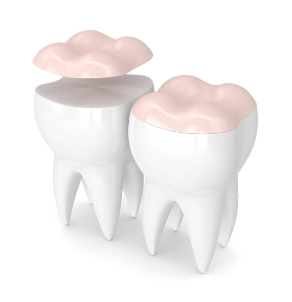istock 3d render of teeth with dental onlay 908217074