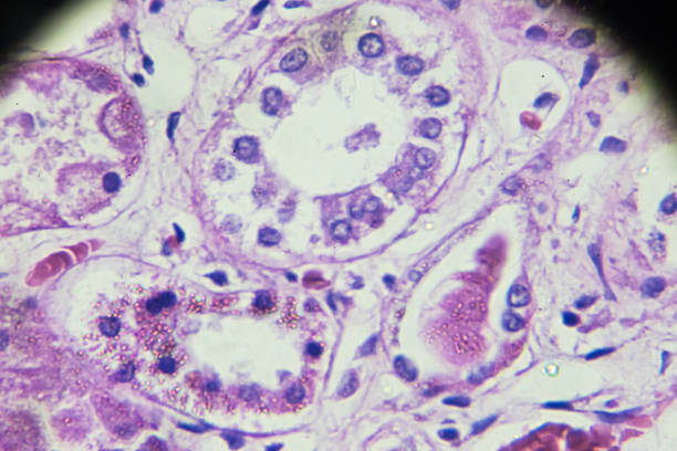 campione di biopsia della nefrite acuta in microscopia - glomerulus foto e immagini stock