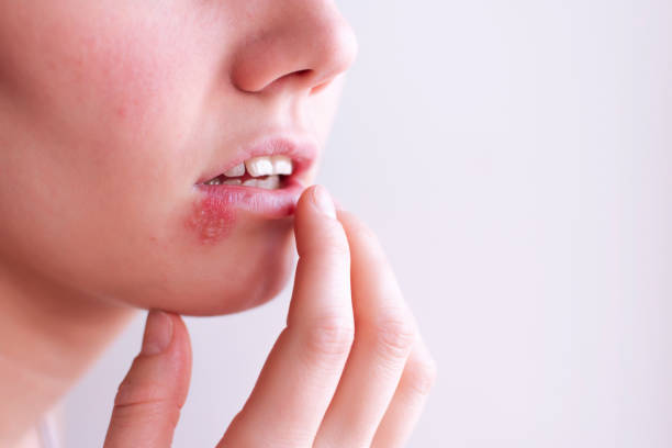 Herpes Rosto feminino com herpes nos lábios herpes zoster fotos de stock, fotos e imagens livres de direitos