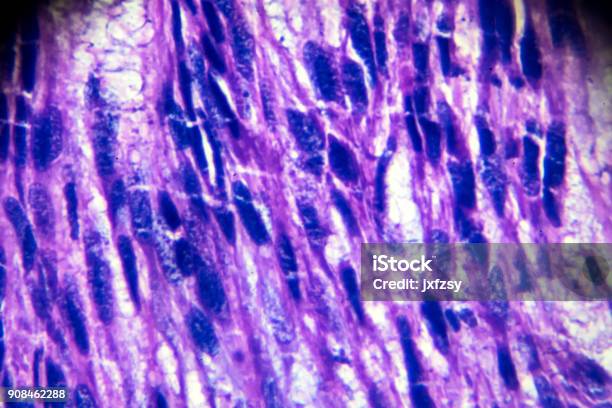 Leiomyoma Biopsy Sample Under Light Microscopy Stock Photo - Download Image Now