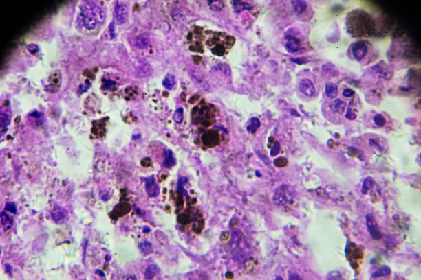 biopsia melanoma bajo microscopia - human tissue histology dermatology human skin fotografías e imágenes de stock