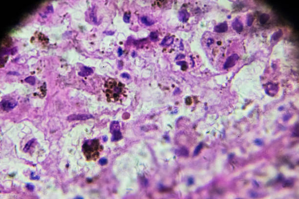 biopsia melanoma bajo microscopia - human tissue histology dermatology human skin fotografías e imágenes de stock