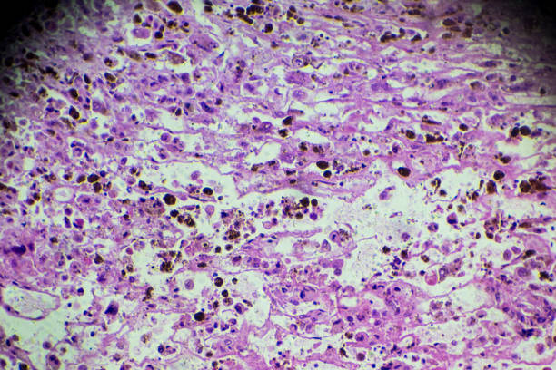 biopsia melanoma bajo microscopia - human tissue histology dermatology human skin fotografías e imágenes de stock