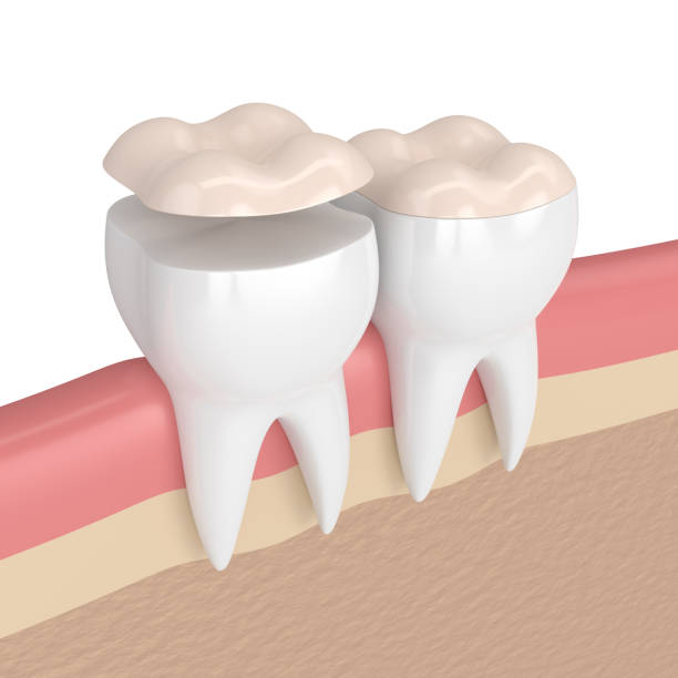 rendering 3d dei denti con onlay dentale - inlaid foto e immagini stock