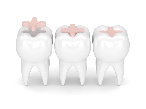istock 3d render of teeth with dental inlay filling 908538614