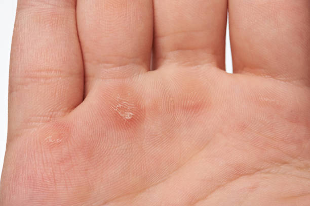 Macro of blister on human hand Macro of blister on human caucasian hand erythema nodosum stock pictures, royalty-free photos & images