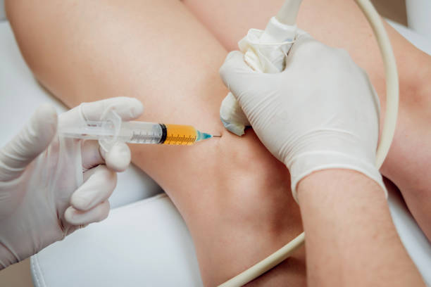 Ultrasound-guided platelet-rich plasma injection of the knee Ultrasound-guided platelet-rich plasma injection of the knee syringe photos stock pictures, royalty-free photos & images