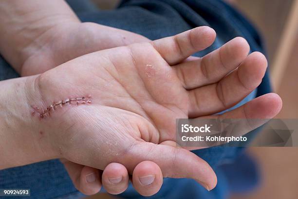 Mano Con Cicatrice - Fotografie stock e altre immagini di Braccio umano - Braccio umano, Chirurgo, Cicatrice