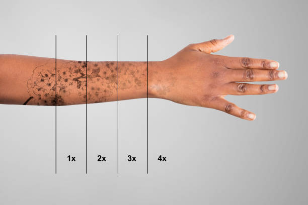 istock Laser Tattoo Removal On Woman's Hand 909313660