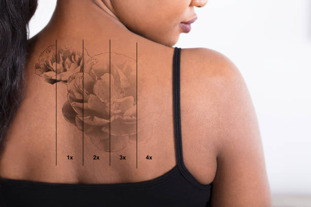istock Laser Tattoo Removal On Woman's Back 909313682