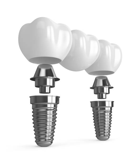 istock 3d render of implants with dental bridge 909412028