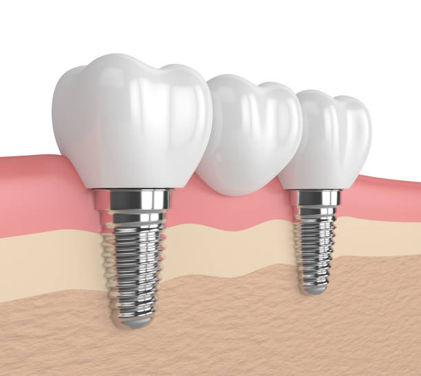 3d render of implants with dental bridge stock photo