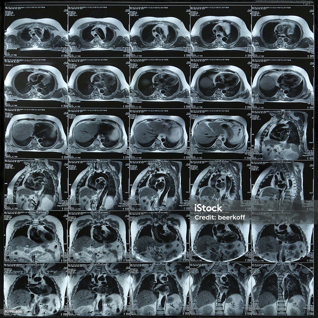 Груди при помощи магнитно-резонансной томографии - Стоковые фото Магнитно-резонансная томография роялти-фри
