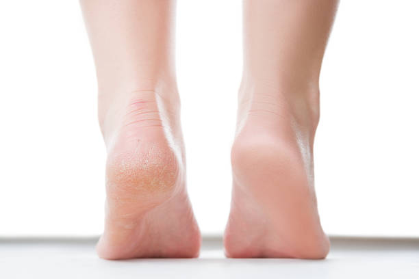 Before after feet care concept, female foot, chiropody isolated on white background Before after feet care concept, female foot, chiropody isolated on white background, studio shot rough and smooth stock pictures, royalty-free photos & images