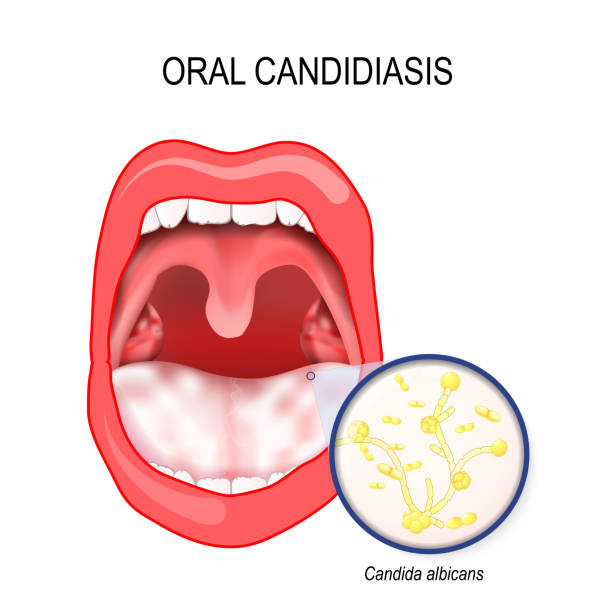 ilustraciones, imágenes clip art, dibujos animados e iconos de stock de candidiasis oral. levadura infección ofl candida albicans la boca. - thrush