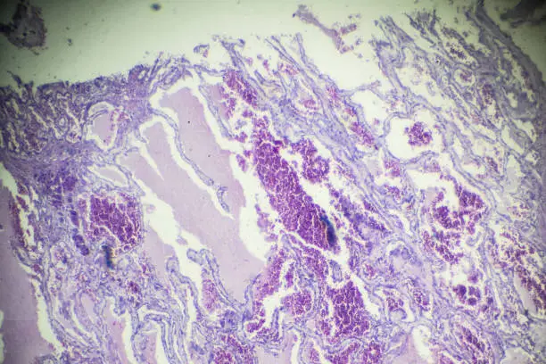 Photo of Hemangioma biopsy under light microscopy