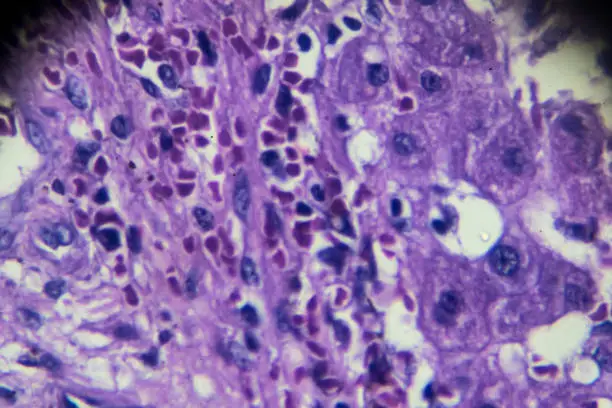 Photo of Hemangioma biopsy under light microscopy