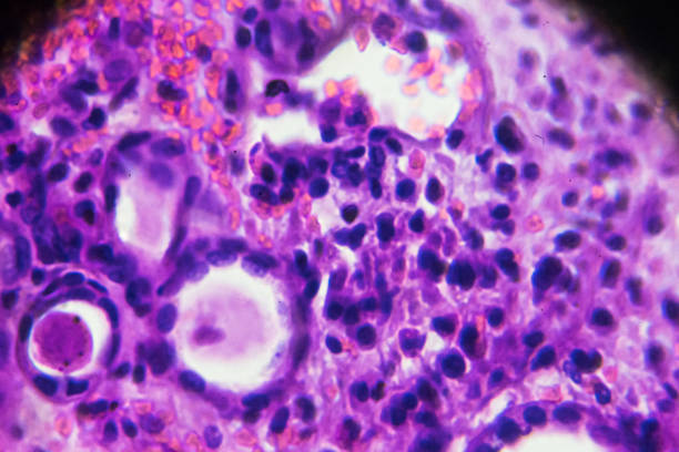 현미경 아래 차 경화 담 관 사 구체 신 염 생 샘플 - glomerulus 뉴스 사진 이미지