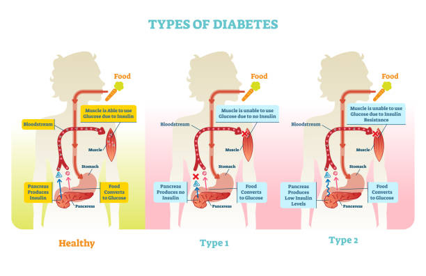 ilustrações, clipart, desenhos animados e ícones de tipos de regime de diagrama de ilustração de vetor diabetes - high seat