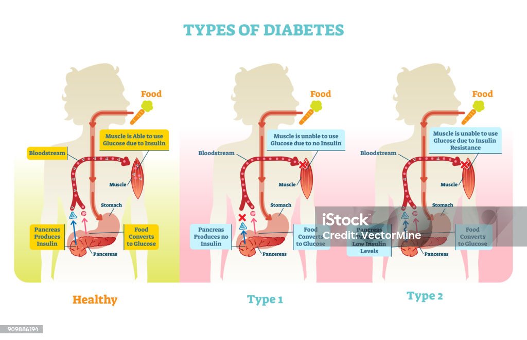 Types of diabetes vector illustration diagram scheme Types of diabetes vector illustration diagram scheme. Medical educational information. Diabetes stock vector