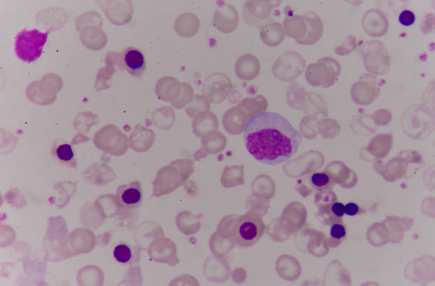 istock Abnormal red blood cells in Blood smear. 909920720