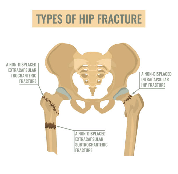 illustrations, cliparts, dessins animés et icônes de types de fractures de la hanche - hip femur ilium pelvis