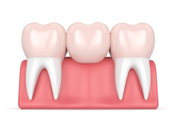 istock 3d render of dental bridge with dental crowns 910060688