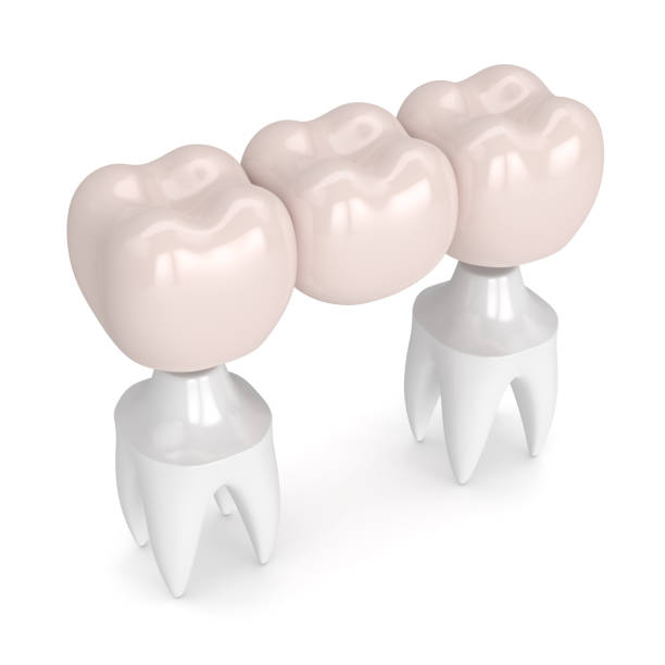istock 3d render of dental bridge with dental crowns 910069082