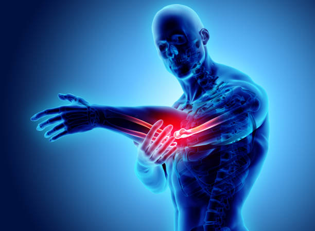 istock 3d illustration of human elbow injury. 910074696