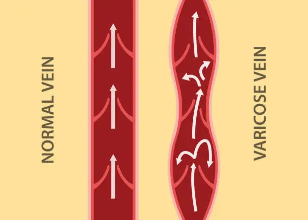 Vector illustration of comparison compare between normal vein and varicose vein in vertical alignment
