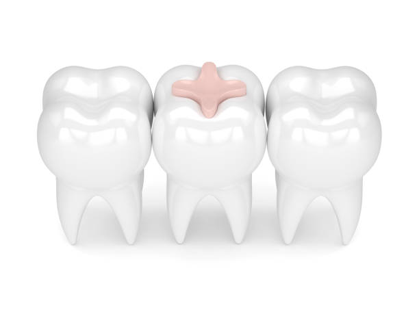 istock 3d render of teeth with dental inlay filling 910461270
