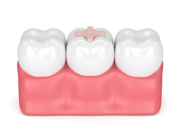istock 3d render of teeth with dental inlay filling 910461412